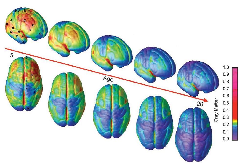 Human cortical development during childhood through early adulthood Gray matter volume peaks around ages 12 14