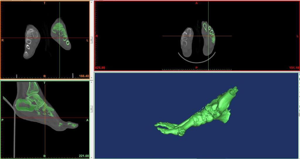 Journal of the Serbian Society for Computational Mechanics / Vol. 8 / No., 204 67 We created a 3D FE model by using MIMICS software 3D DICOM CT slices (Fig. 2a).