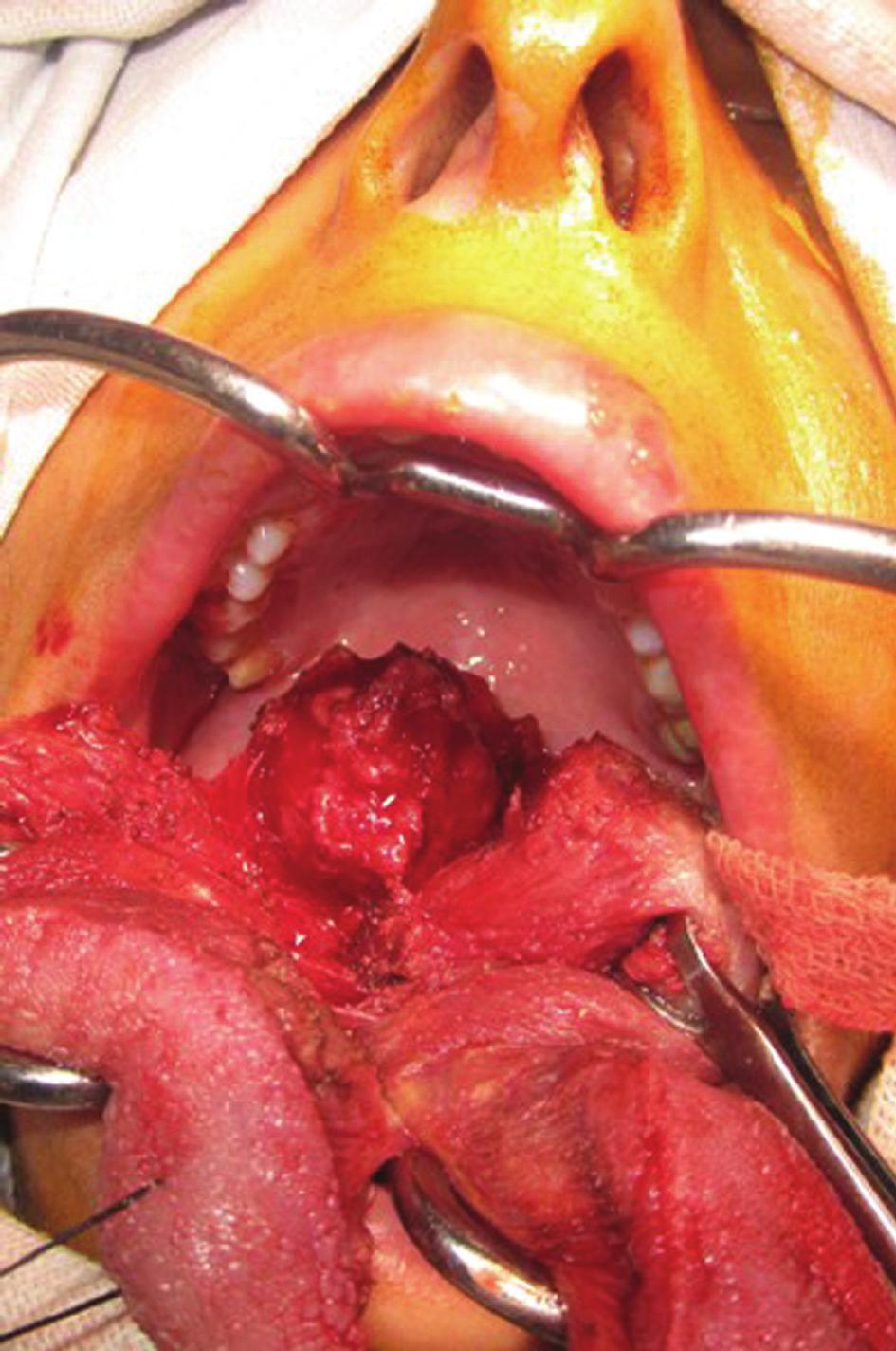 The thyroid gland was normally located in the anterior neck (Figure 1).