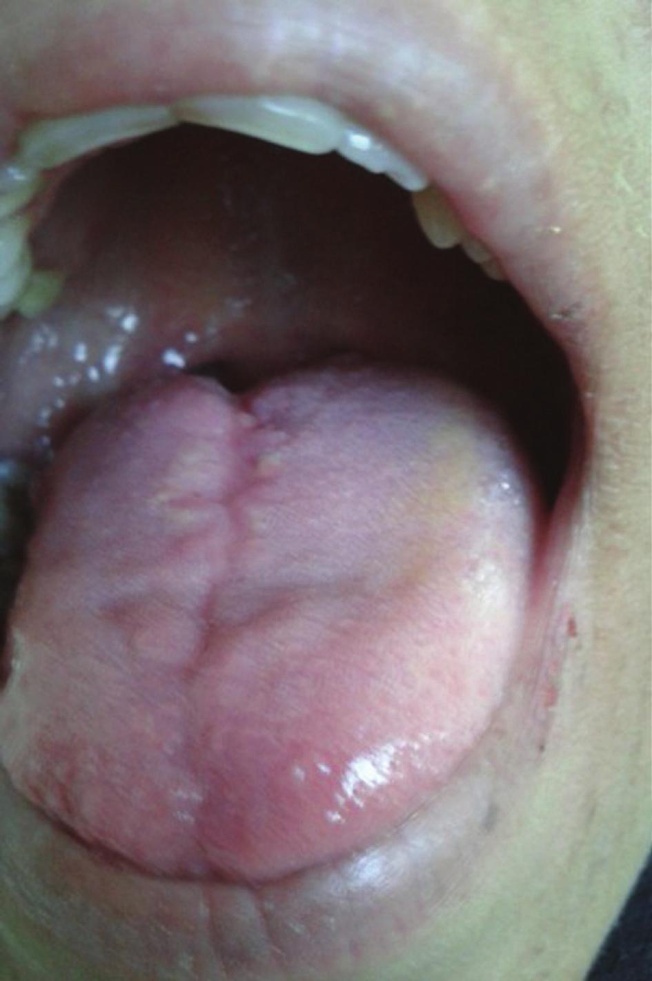 Patient was started on oral feeding on the first postoperative day and was decannulated on the 5th day.