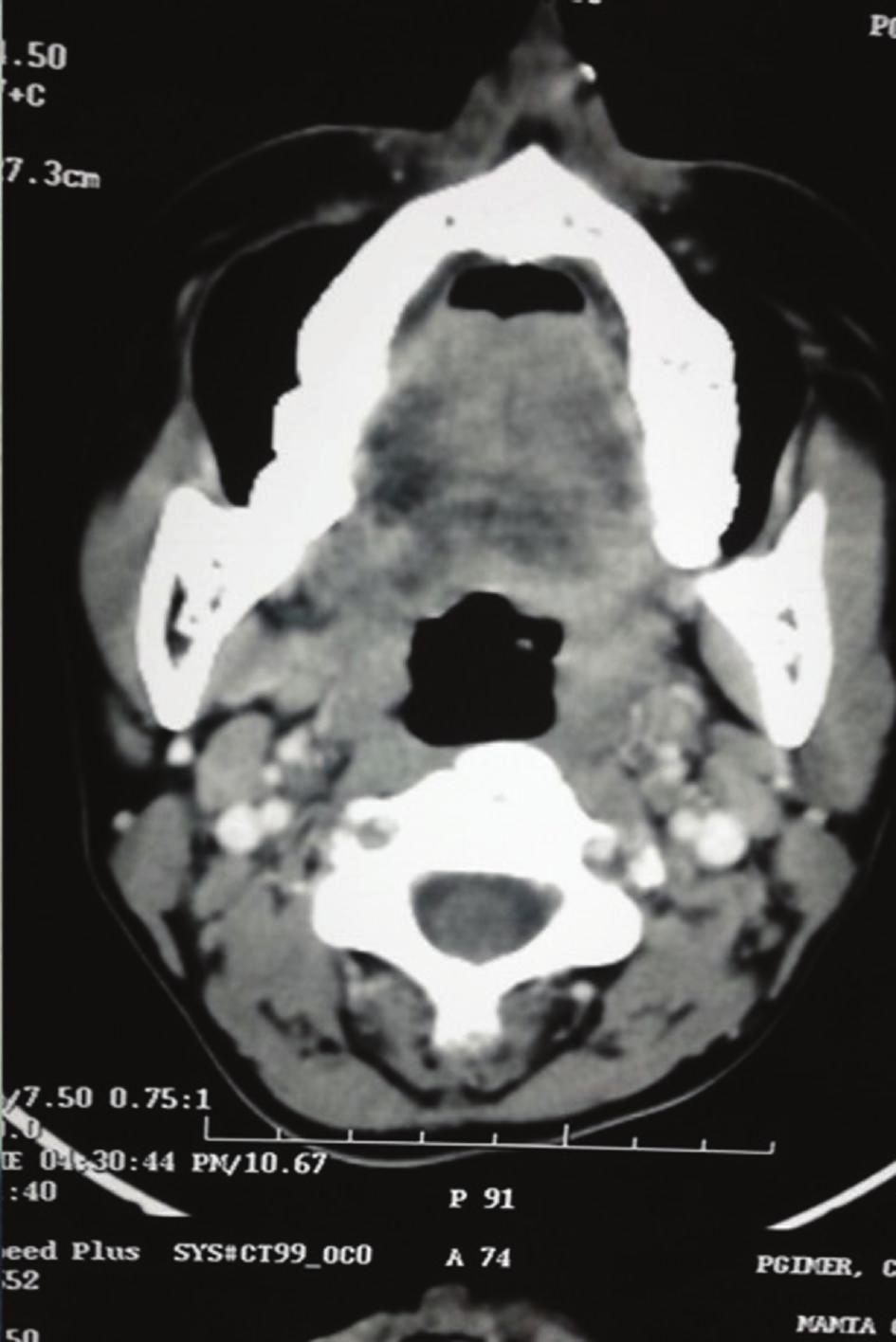 A postoperative computed tomography was done after 2 months of the operation which showed complete removal of the tumor.