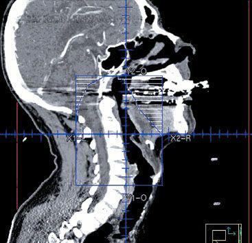 Digitally reconstructed radiograph depicting a classical lateral field designed to encompass the T2 pyriform sinus cancer.
