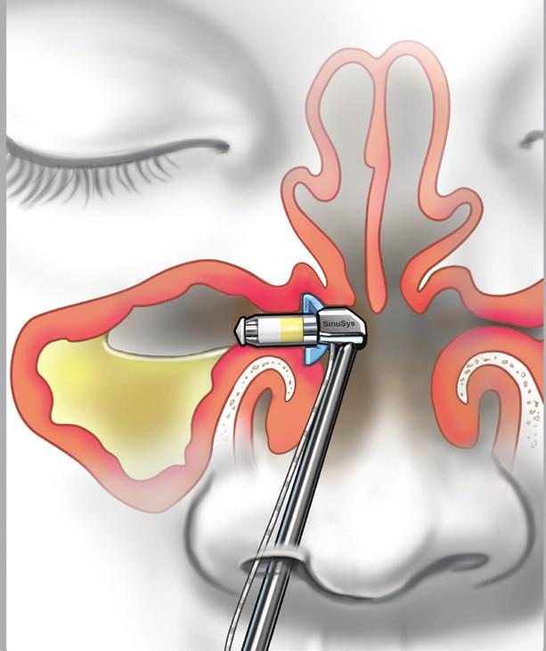 Vent-Os Sinus Dilation System A Fast and Effective In-Office Procedure Dilation of the sinus ostia using the SinuSys Vent-Os Sinus Dilation System is a unique and cost effective approach for the