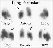 Stage II Using 133 Xe Inhalation: Predicted Postoperative (PPO) FEV 1 of < 1 L is indicative of physiologic inoperability. Kristersson S et al.