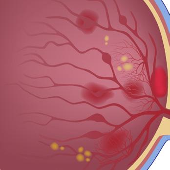 Omega-3s (EPA/DHA) and Diabetic Retinopathy When high blood sugar levels are not managed; damage to the blood vessels of the light sensitive tissue in the retina lead to Diabetic Retinopathy This