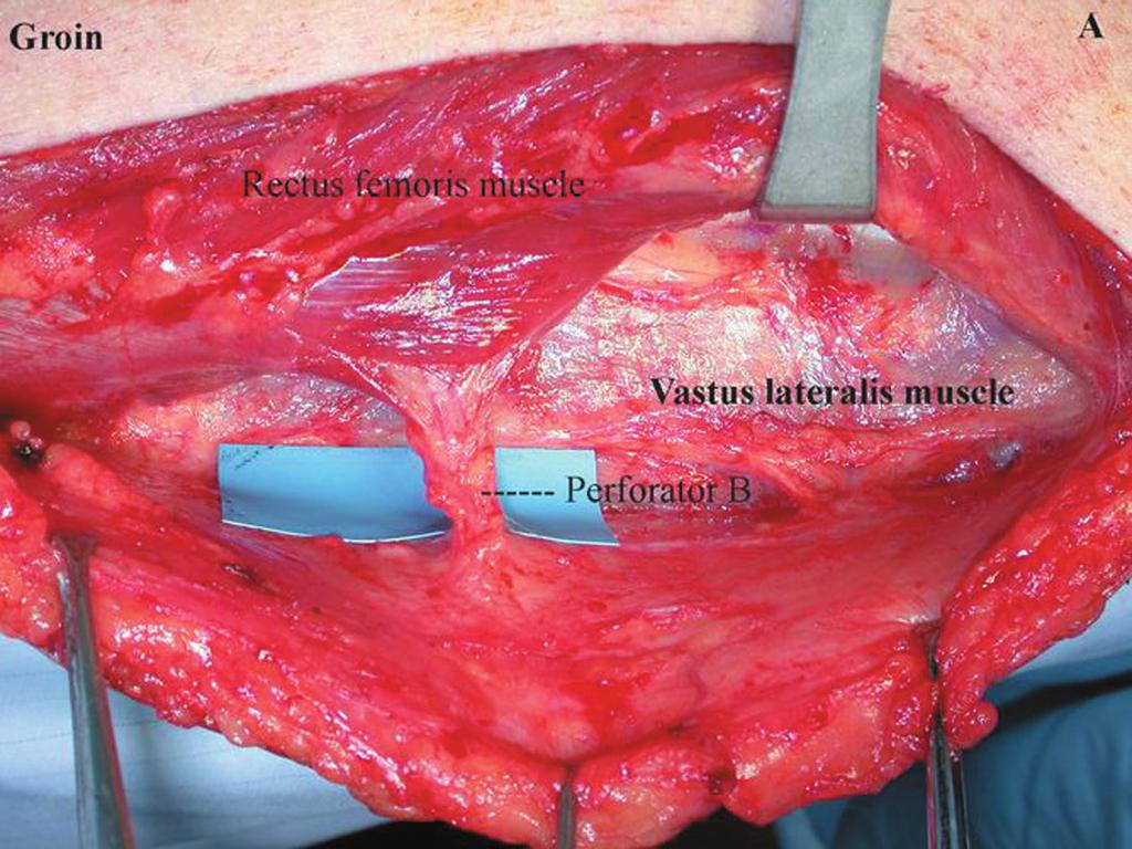 FIGURE 5. An intraoperative photograph of the right thigh showing perforator B exiting the rectus femoris muscle to enter the skin (A).