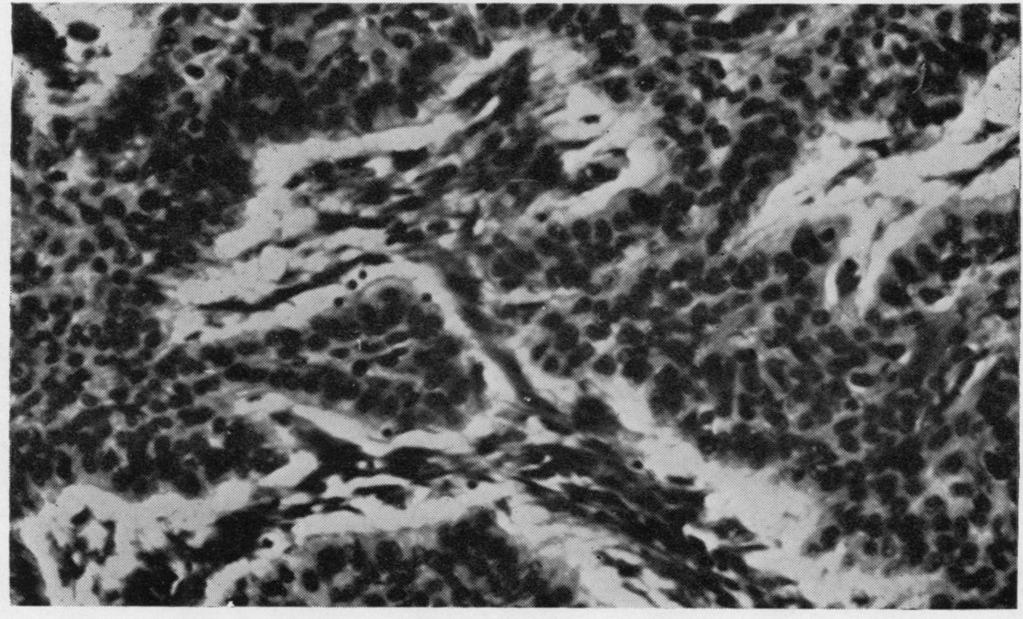 The concentric whorls of squamous cells in the right-hand side of the photograph give the impression of incomplete keratinization.
