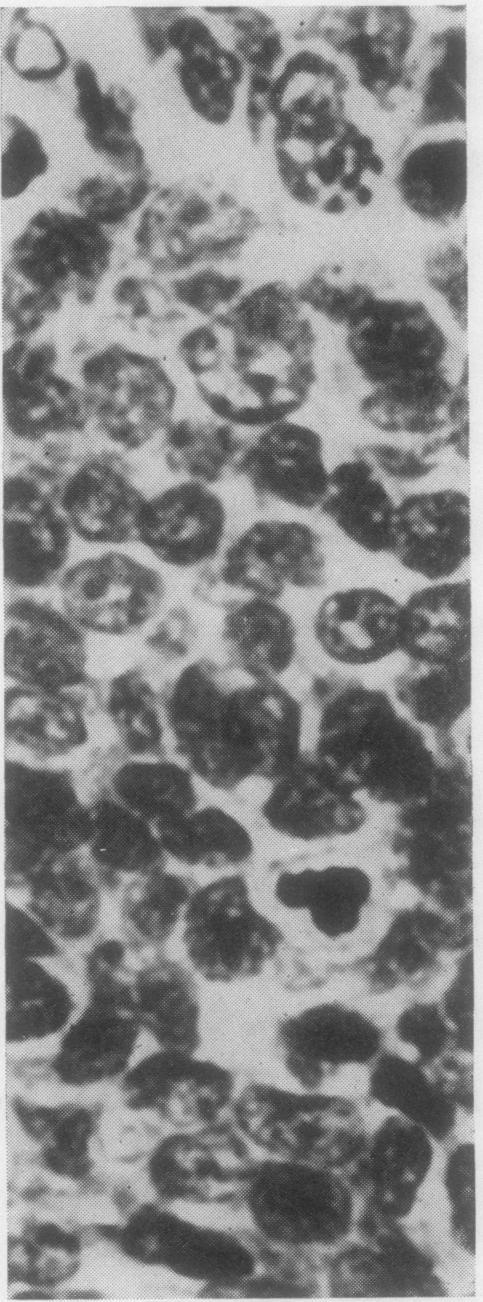 rim around the periphery. Haematoxylin and eosin x 34. J Clin Pathol: first published as 10.1136/jcp.0..18 on 1 March 1967.