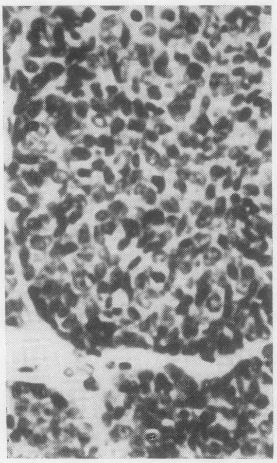 There is clumping of tumour cells but palisading is absent. Haematoxylin and eosin x 300.