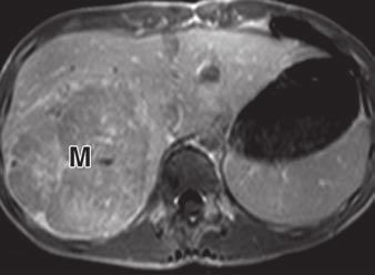 14 Hepatocellular carcinoma in 15-year-old boy who presented with abdominal pain, abnormal liver function tests, and elevated serum α-fetoprotein level.