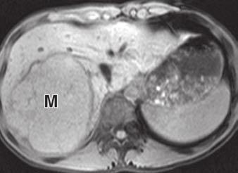 , xial T1-weighted image with fat saturation shows large well-circumscribed right hepatic mass (M) with decreased signal intensity compared with adjacent normal hepatic