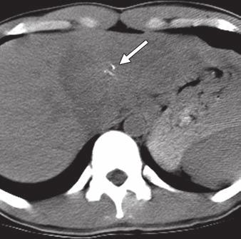 Hepatocellular Carcinoma Hepatocellular carcinoma (HCC) is the most common primary hepatic malignancy in adults but is rarely seen in the pediatric population.