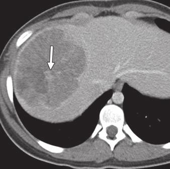 , xial contrast-enhanced CT image shows numerous hypoenhancing liver masses (arrows)., xial fused PET/CT image shows increased metabolic activity (arrows) corresponding with hepatic metastases. Fig.