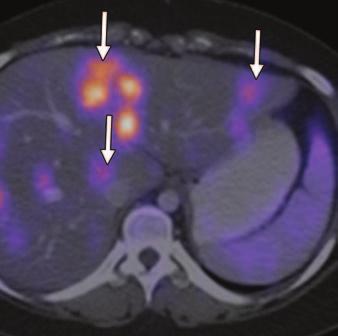 , Coronal contrast-enhanced CT image shows large enhancing hepatic metastasis (M). lso noted is primary right adrenocortical carcinoma (arrows). malignancy in the pediatric population.