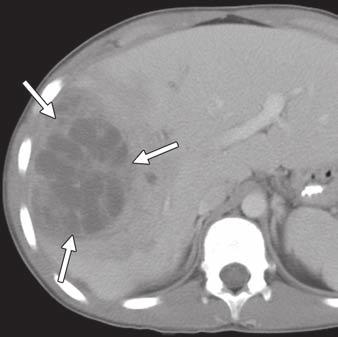 Hepatic pyogenic abscess can occur via several different pathways, such as hematogenous spread of infection via the hepatic artery, portal venous spread from intestinal infectious processes, biliary