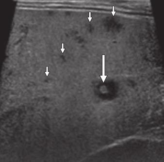 lood culture was positive for Candida infection., Transverse ultrasound image shows multiple anechoic (short arrows) and targetlike (long arrow) lesions.