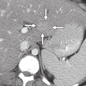 xial contrast-enhanced CT image shows focal fatty infiltration in medial segment of left hepatic lobe (arrow). Fig.