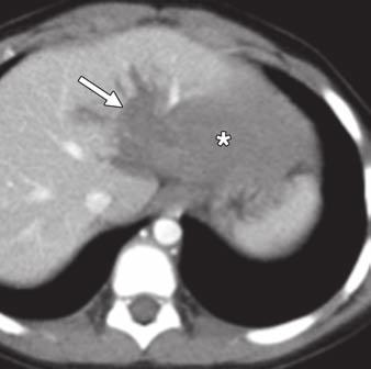 xial contrast-enhanced CT image shows diffusely fatty liver with focal sparing (arrows) in lateral segment of left hepatic lobe, mimicking hyperdense liver lesion.