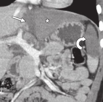 Focal sparring is seen as a relatively hypoechoic lesion in an otherwise echogenic liver. On CT, areas of fatty liver involvement are hypodense relative to the spleen.
