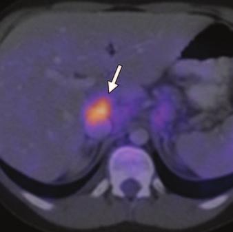 , xial fused PET/CT image shows hypermetabolic activity (arrow) corresponding to mass in, which proved to be extrahepatic lymphadenopathy. hepatic arterial and portal venous systems.