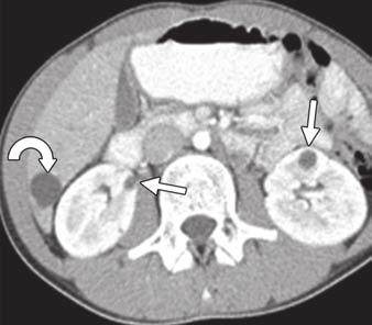 Otherwise, polycystic liver disease less commonly occurs in patients with autosomal-dominant polycystic liver disease, which is not typically associated with renal cysts and is not thought to