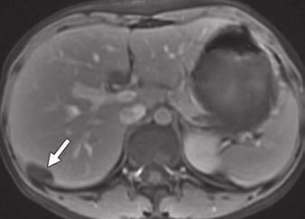 Focal infantile hepatic hemangioma is thought to be the hepatic form of cutaneous rapidly involuting congenital hemangioma (RICH) (Fig. 6).