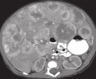 7 Multifocal subtype of infantile hemangioma in 2-month-old girl who presented with hepatomegaly and multiple