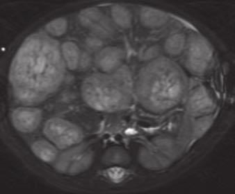 , xial unenhanced CT image shows multiple low-attenuation lesions throughout liver.