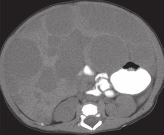 D, xial contrast-enhanced CT image obtained during delayed phase shows enhancement of hepatic lesions.