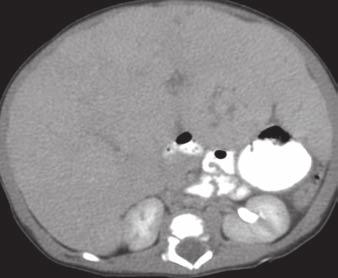 F, xial contrast-enhanced T1-weighted image shows contrast enhancement within hepatic lesions.