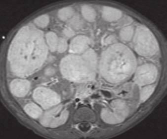 Infantile hepatic hemangiomas typically appear on CT as low-attenuation masses that may contain calcification.