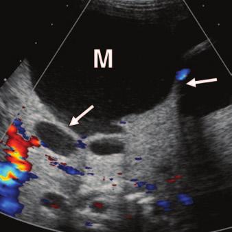 , xial unenhanced CT image shows subtle liver contour abnormality (arrow) in left hepatic lobe.