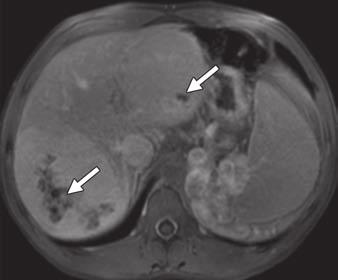 C, xial T1-weighted image with fat saturation obtained during delayed contrast-enhancement phase shows partial enhancement of central scars (arrows).