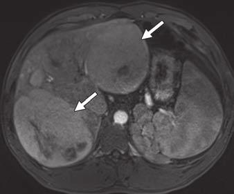 transformation of hepatic parenchyma without intervening fibrous septa.
