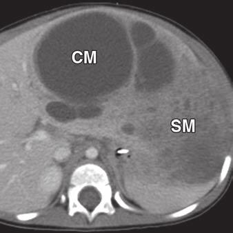 If regenerative hepatic nodules are small ( 0.5 cm), CT and MRI may show a normal appearance of the liver. However, larger regenerative hepatic nodules (0.5 4.