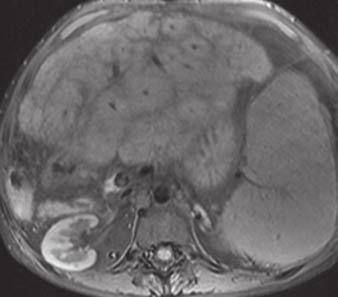 11 Regenerative hepatic nodules in 20-year-old woman with hepatic cirrhosis and portal hypertension after surgical resection of hepatoblastoma and radiation treatment.