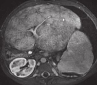 On MRI, regenerative hepatic nodules are isointense on T1- weighted images and iso- to hypointense on T2-weighted images. s with CT, they usually show diffuse contrast enhancement (Fig. 11).