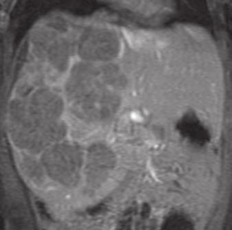 The tumor typically shows heterogeneous contrast enhancement (Fig. 12). Downloaded from www.ajronline.org by 148.251.232.