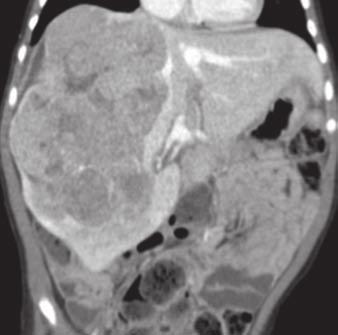 12 Hepatoblastoma in 15-month-old boy who presented with large palpable abdominal mass and markedly elevated serum α-fetoprotein