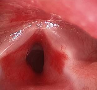 Other Anatomic Areas of Concern Example of airway IH Nasal tip IH Ulcerated IH of the lips AIRWAY Most patients with IHs of the airway have subglottic involvement causing biphasic stridor
