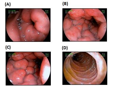 416 surgery the patient outcome complicated with recurrent episodes of acute pancreatitis in association with peripancreatic fistula and focal areas of fat necrosis of the pancreas.