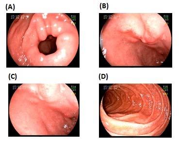417 Fig. 2 From A to D: EDA before discharge: (A) antrum; (B) bulb 1; (C) bulb 2; (D) duodenal second portion.