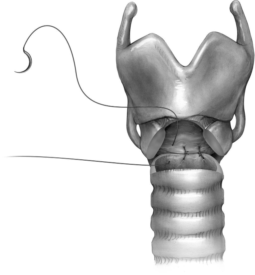 56 J.D. Mitchell Figure 8 Laryngotracheal resection for circumferential stenosis at the cricoid level.