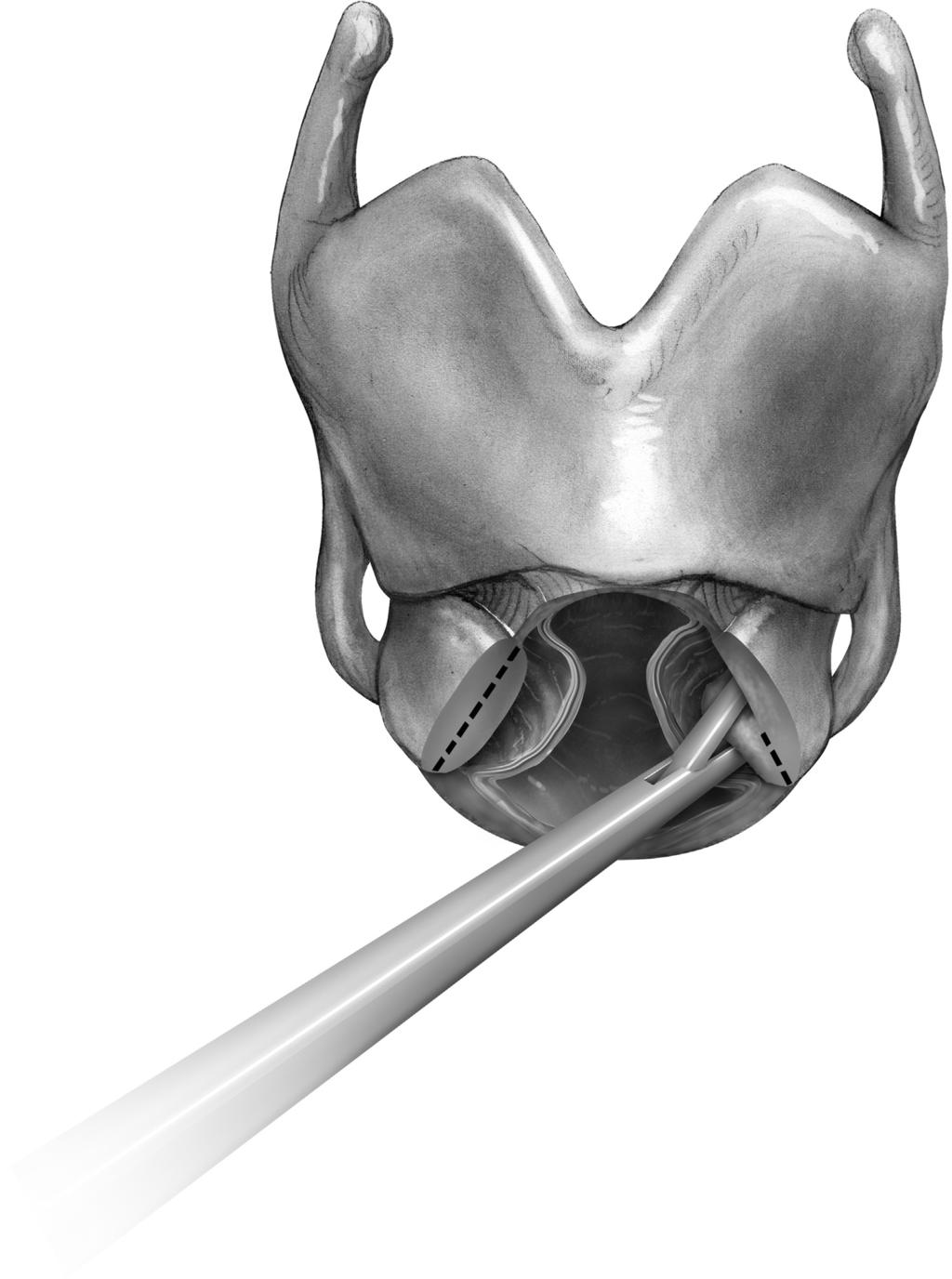 Laryngotracheal resection and reconstruction 59 Figure 11 Tailoring cricoplasty.