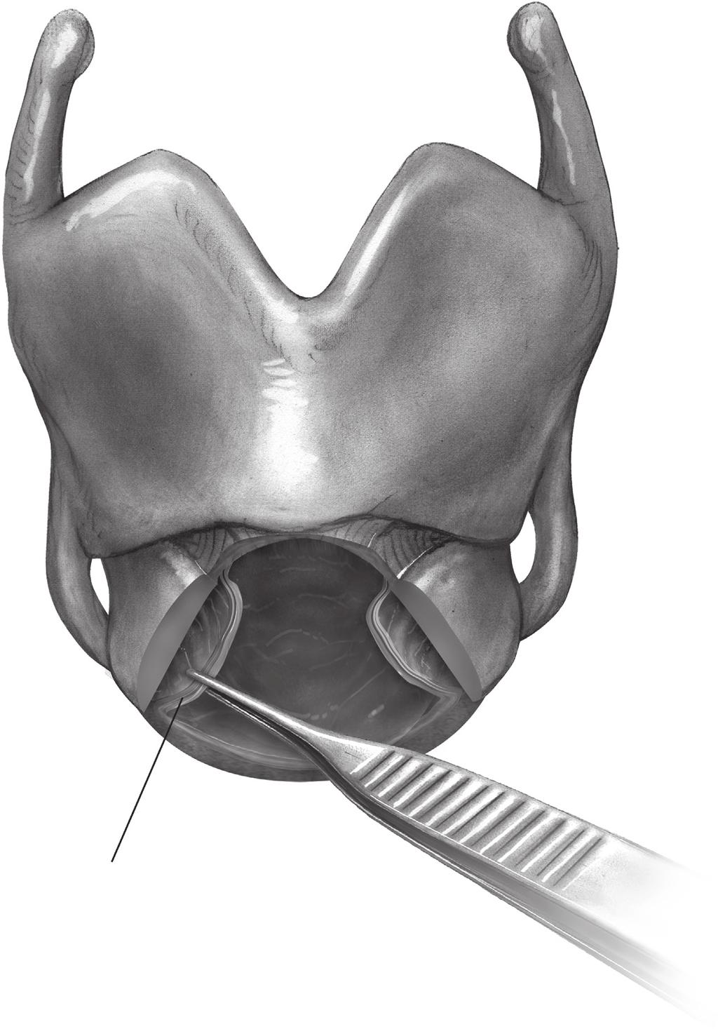 60 J.D. Mitchell Mucosa Figure 12 Tailoring cricoplasty.