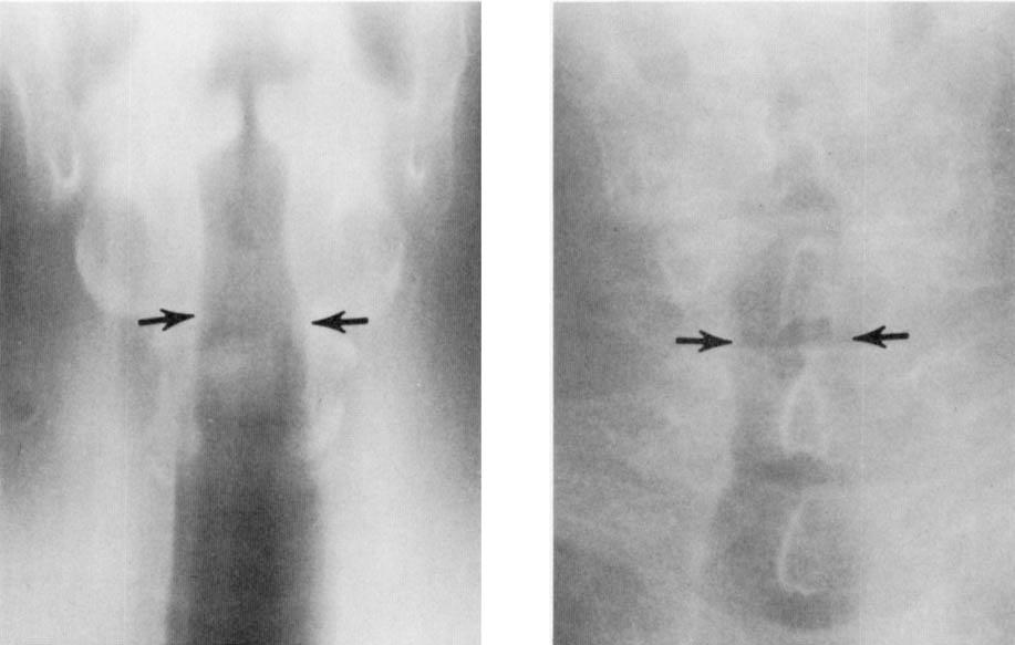 (A) Preoperative view in a tomographic cut and (B) postoperative view in a soft-tissue roentgenogram. Arrows indicate the diameter of the airway at the level of the lower border of the cricoid plate.