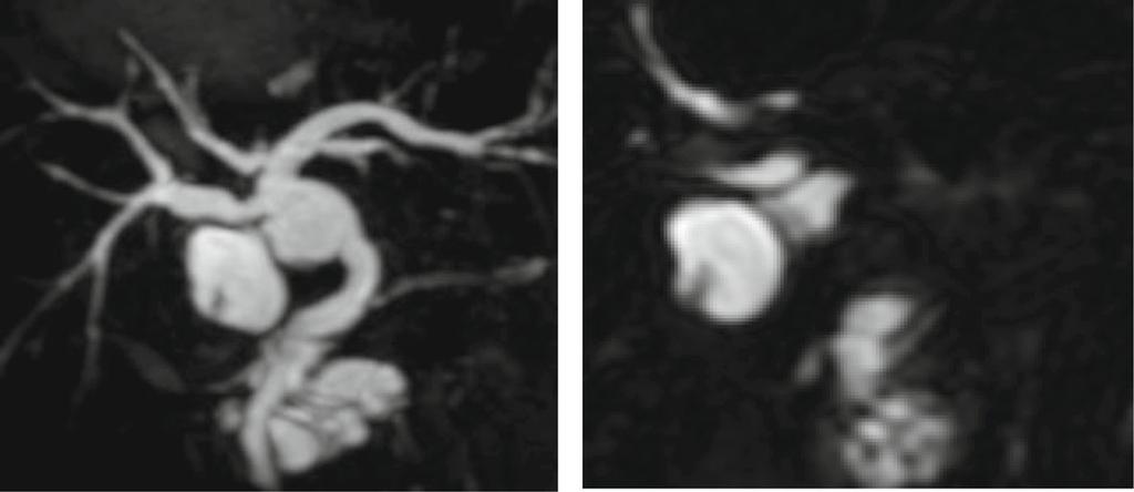 Mori et l. Surgicl Cse Reports (2017) 3:113 Pge 3 of 5 Fig. 2, Mgnetic resonnce imging (MRI) showed pncreticoiliry mljunction with cystic dilttion of the common ile duct (type I [Todni clssifiction]).