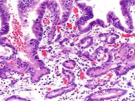 Differences between Japanese & Western pathologists in the evaluation of gastric biopsies for neoplasia 16 % of Japanese cancers diagnosed as dysplasia by