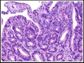 .. obvious carcinoma has both cytological and structural abnormalities...following histologic features.