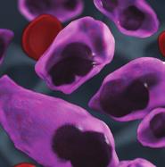 About Multiple Myeloma Understanding multiple myeloma Multiple myeloma: a type of cancer that starts in blood cells 4 There are 3 main types of blood cells in the body: 4 White blood cells, which